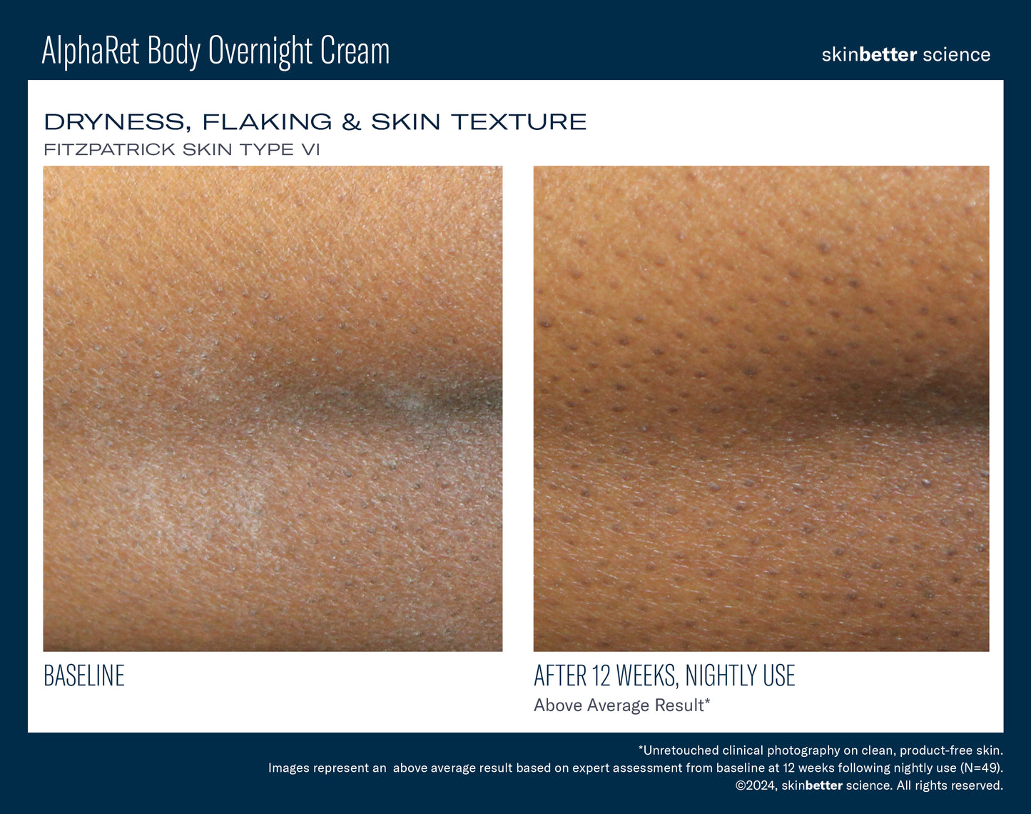 AlphaRet Overnight Body Cream