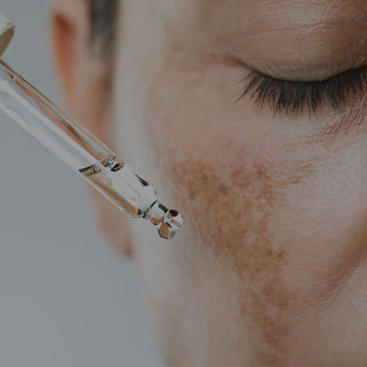 Dark Spots, Hyperpigmentation, melasma