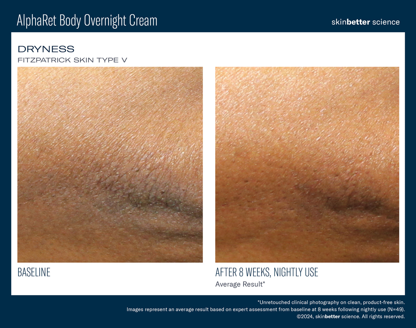 AlphaRet Overnight Body Cream