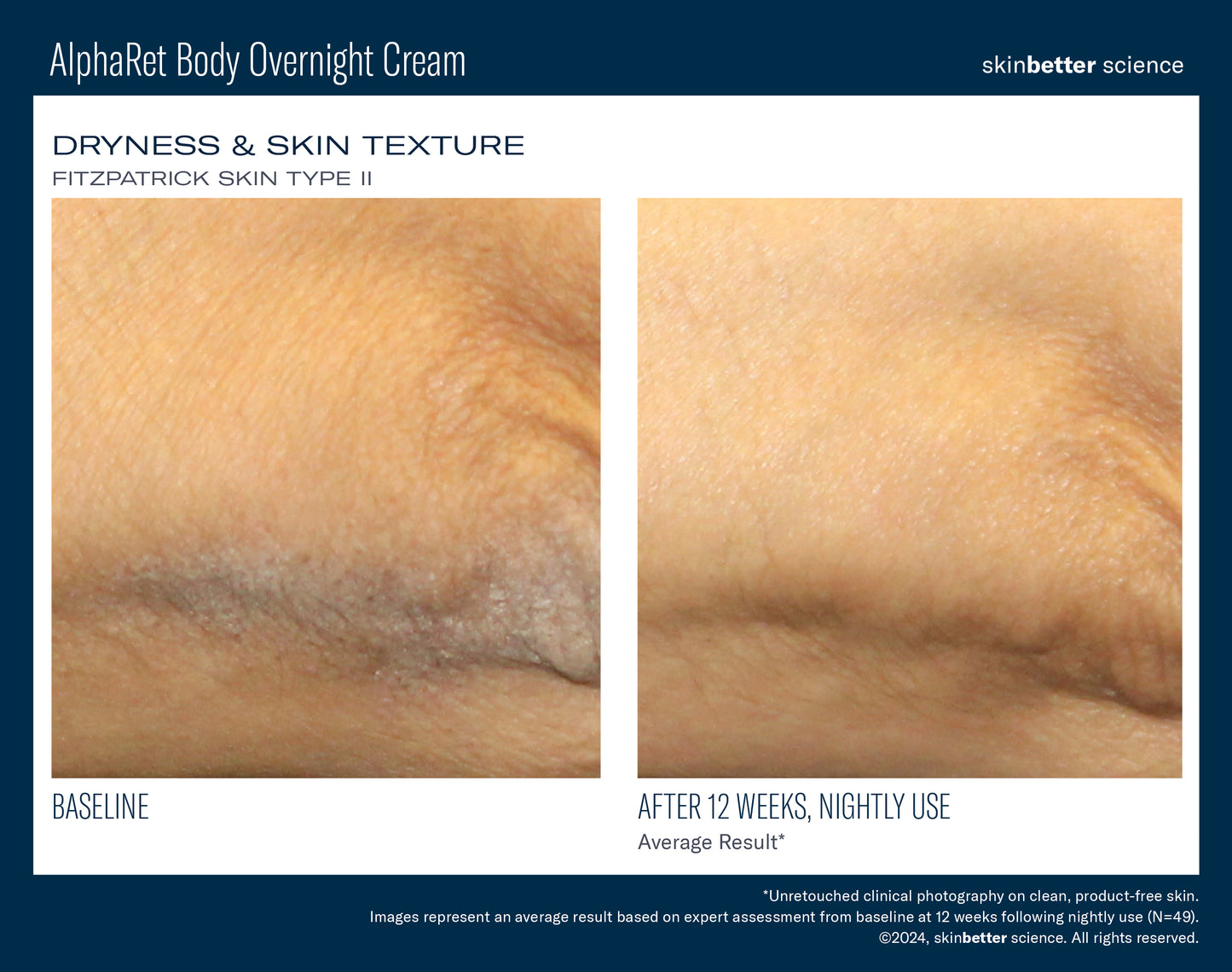 AlphaRet Overnight Body Cream